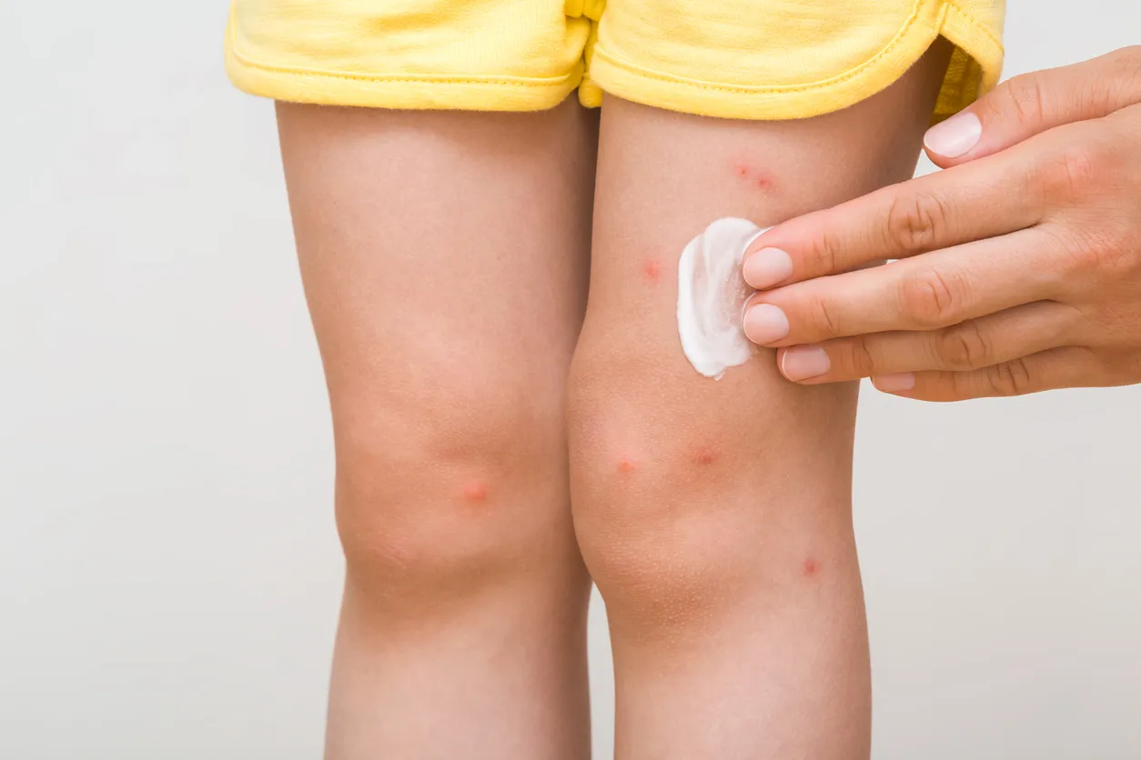 Una madre joven aplica unguento blanco en la pierna de su hija. Erupción roja tras una picadura de mosquito